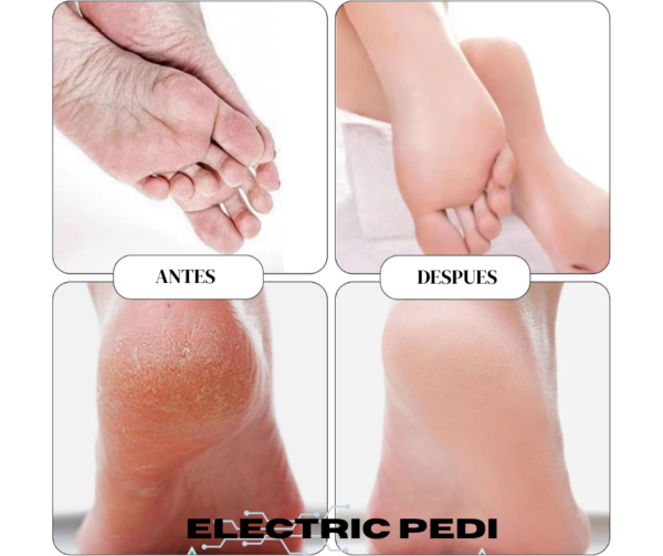 Eliminador de Callos - Máquina de Pedicure - Promo 2x1