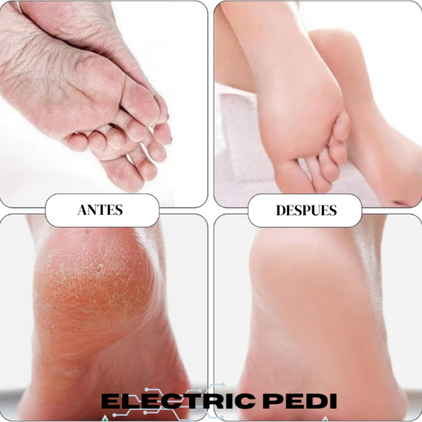 Eliminador de Callos - Máquina de Pedicure - Promo 2x1